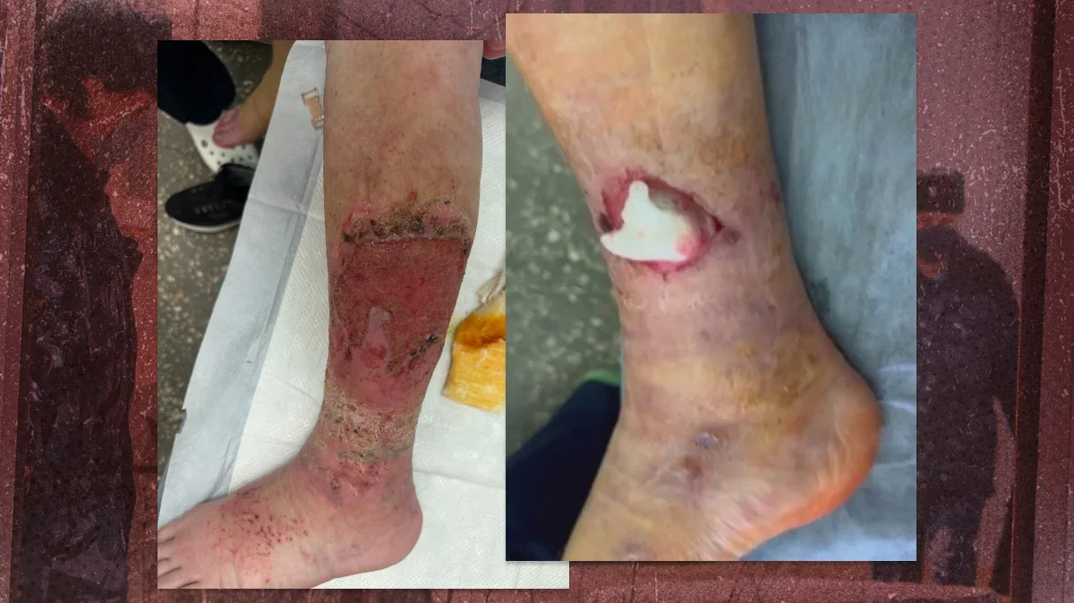 This is what Kulko’s legs looked like immediately after his release.