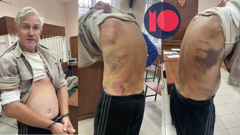 Следы пыток на теле активиста Александра Демиденко. Фото: «Можем объяснить»